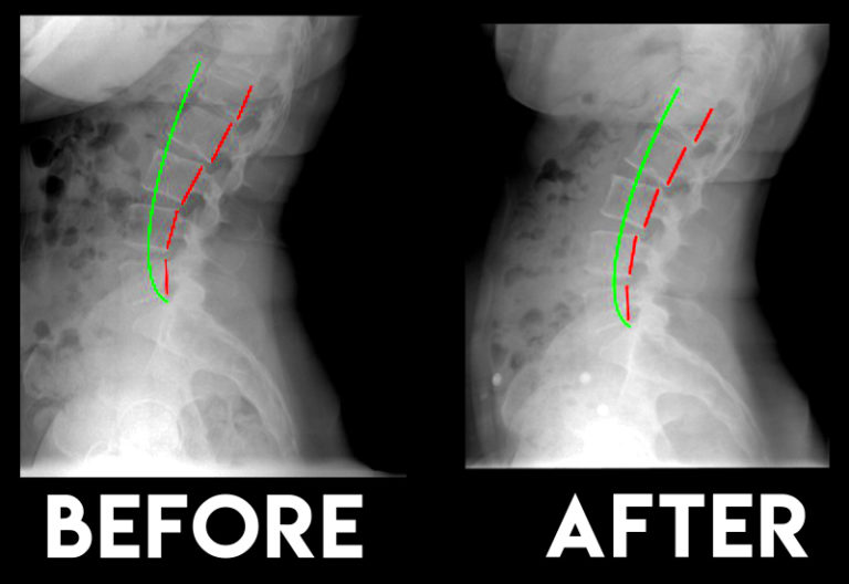 Before and After Transformations | Comprehensive Chiropractic, Physical
