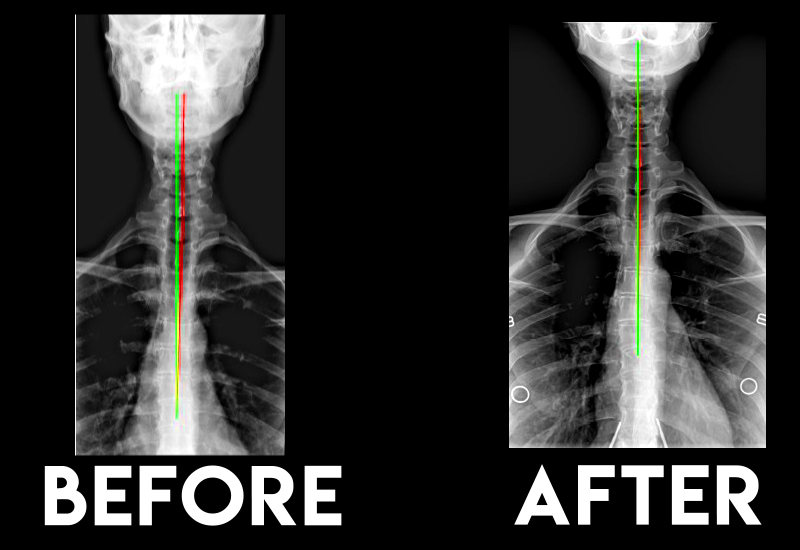 Before and After Transformations | Comprehensive Chiropractic, Physical